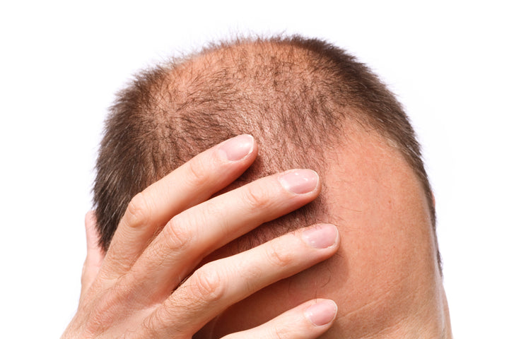 Male Pattern Baldness